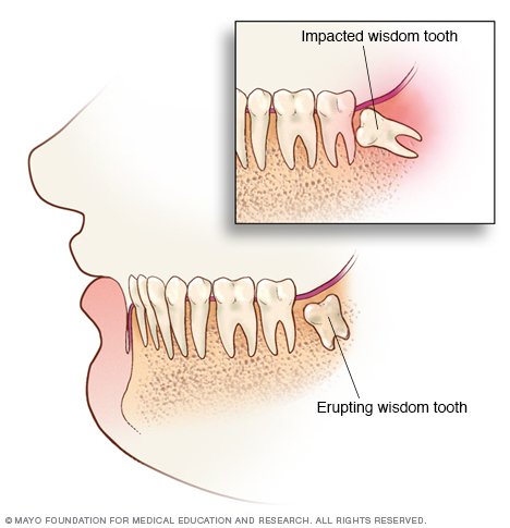 Tramadol for wisdom teeth pain